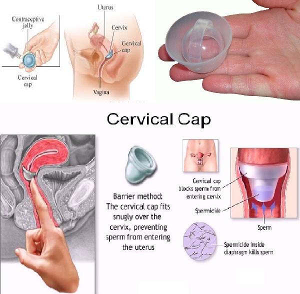 cervical cap, கருத்தடை, சர்விகல் கேப், birth control, cervical cap birth control, 