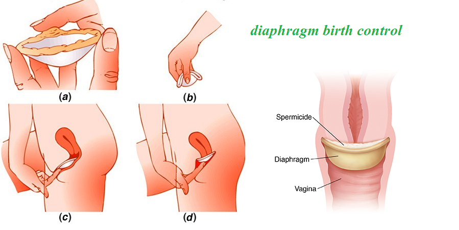 diaphragm, diaphragm birth control, birth control, கருத்தடை, டையபிரகம், 