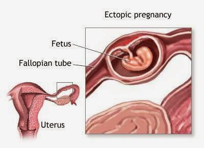 ectopic pregnancy, 