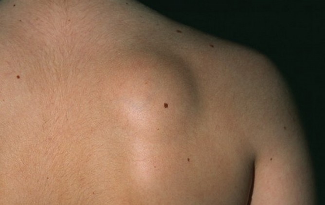 Lipoma, Lipoma images, கொழுப்பு கட்டி, கொழுப்பு கட்டிகள், கொழுப்பு கட்டிகள் நீக்கும் முறை,