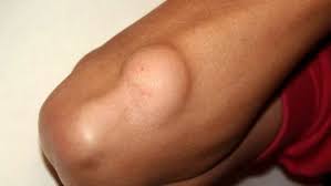 Lipoma, Lipoma images, கொழுப்பு கட்டி, கொழுப்பு கட்டிகள், கொழுப்பு கட்டிகள் நீக்கும் முறை,