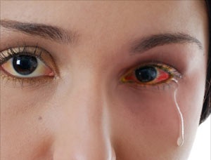 madras eye, madras eye prevention, madras eye solution,