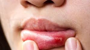 mouth problem, lips problem,