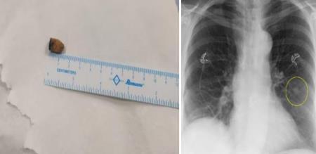 Doctors shocked A teenager lived with a pen cap stuck in his lung for 21 years