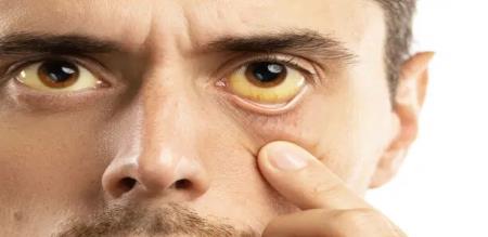 This reason jaundice Understand and act